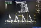 ESTUDIO INTRAUTERO ECO DOPPLER FETAL DIPLOMATURA EN ECO FETAL REALIZADA  POR EL DR. MIGUEL ANGEL TORRES.