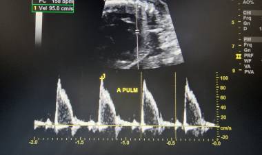 ESTUDIO INTRAUTERO ECO DOPPLER FETAL DIPLOMATURA EN ECO FETAL REALIZADA  POR EL DR. MIGUEL ANGEL TORRES.